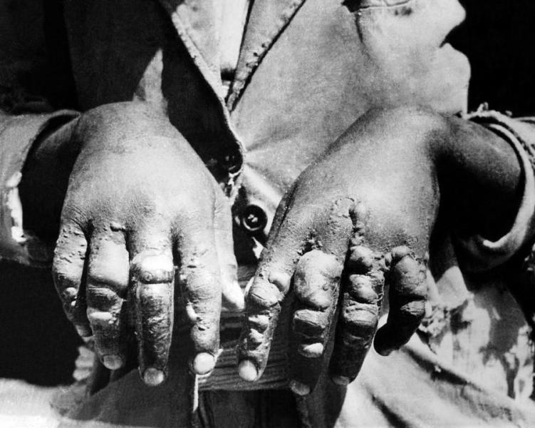 Mustárgáz okozta sérülések